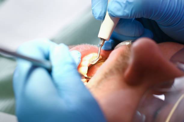 Best Emergency Dentist for Lost Fillings or Crowns in Bound Brook, NJ
